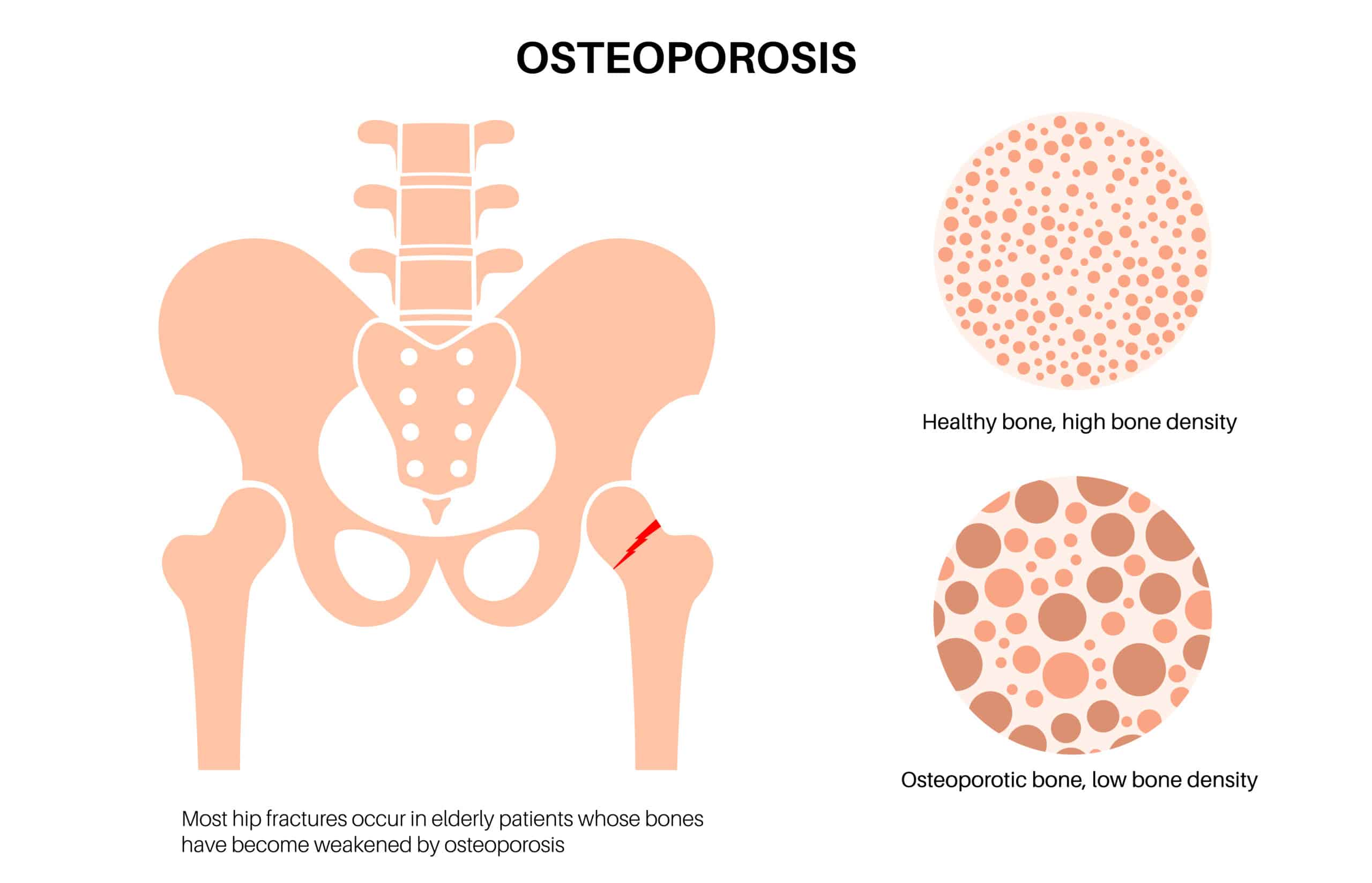 image of hip region & what osteoporotic bones look like